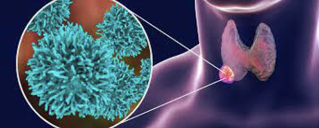 Hashimotos: What is it, and can it be helped?